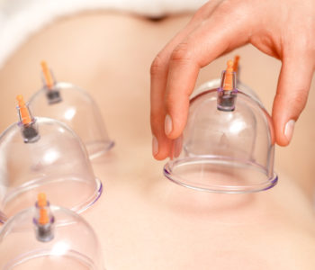 Hand puts on vacuum cups of medical cupping therapy on woman's back, close up, chinese medicine.